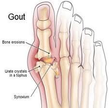 High level of Uric acid and Gout