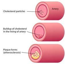 Cholesterol Free Life-Control Cholesterol Naturally