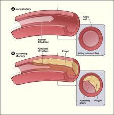 Cholesterol deposition 